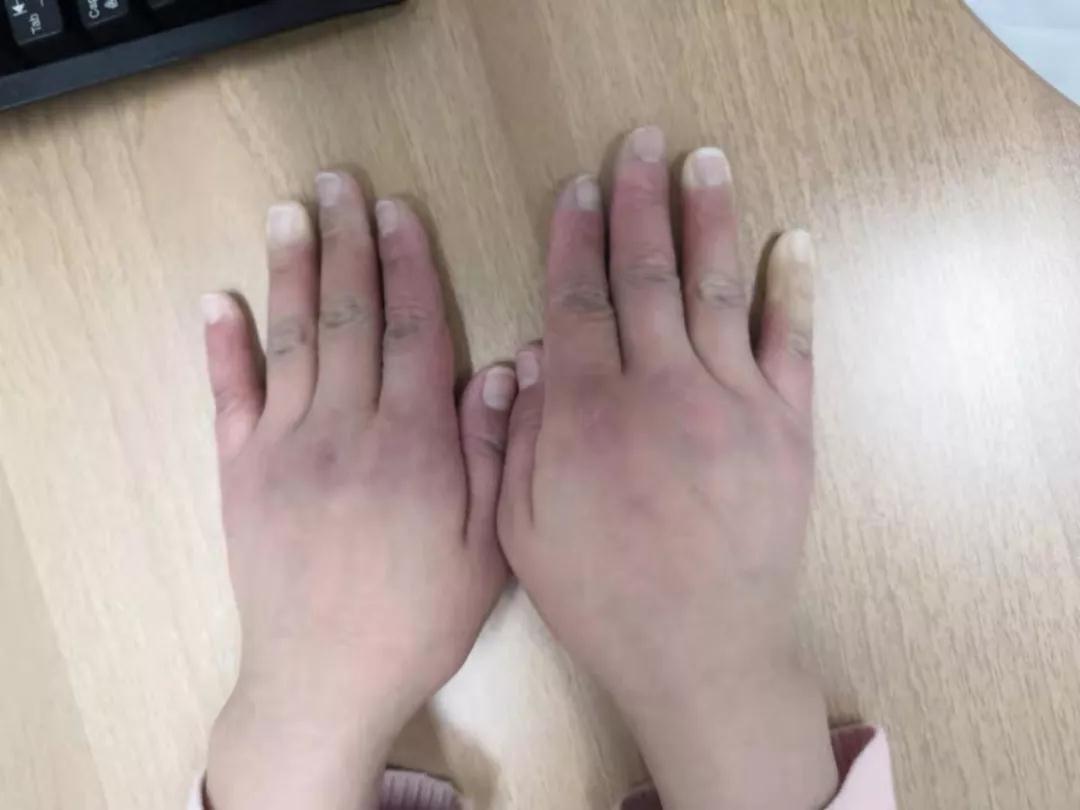 “手指、腳趾發(fā)白、發(fā)紫……”這些“小毛病”千萬別大意