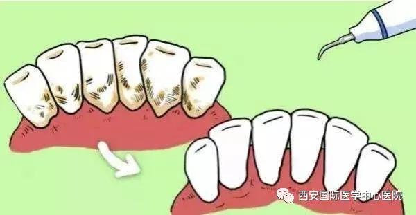 牙齒上的黃斑好難看，三招告訴你如何預(yù)防氟斑牙