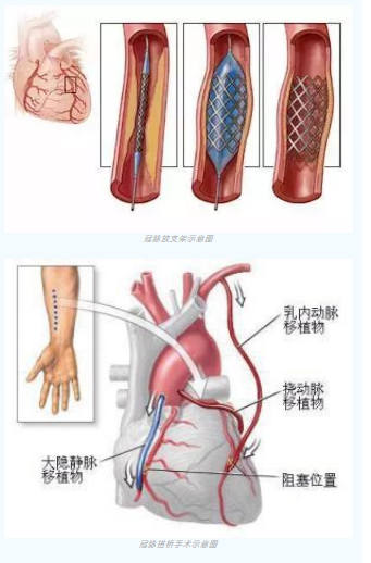 魚與熊掌不可兼得？冠脈雜交手術(shù)一站式解決問題