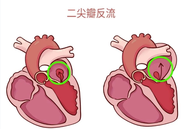 體檢報告里的心臟瓣膜反流，你讀懂了嗎？